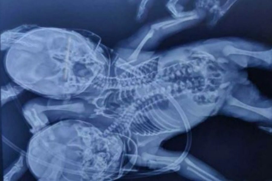 Γεννήθηκε μωρό με δύο κεφάλια, τρία χέρια και δύο καρδιές