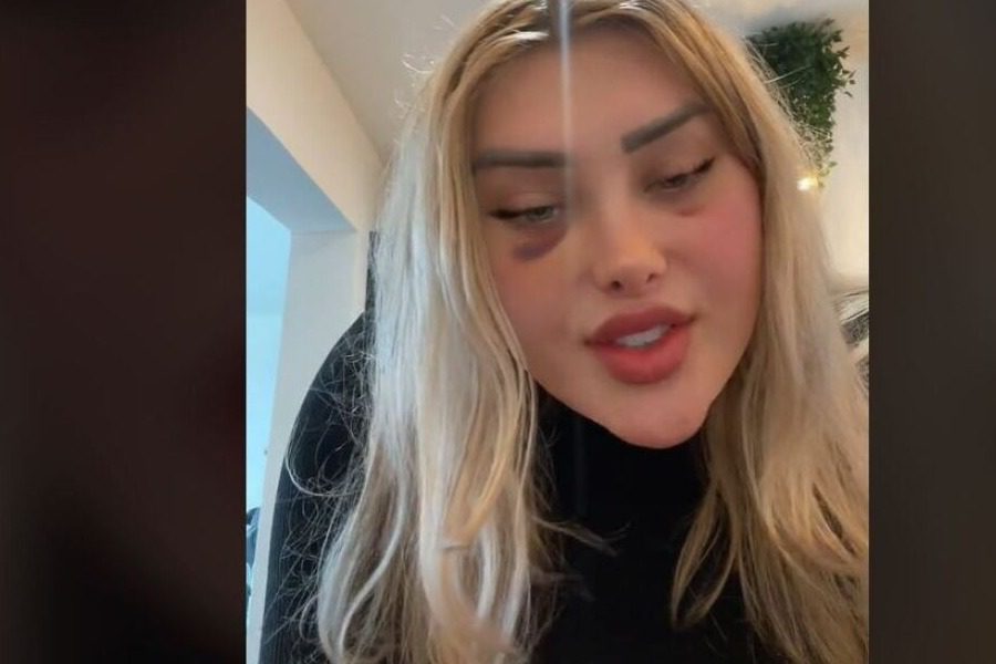 Μοντέλο του OnlyFans: «Εξερράγη το κεφάλι μου κατά τη διάρκεια πτήσης μετά από πλαστική επέμβαση»