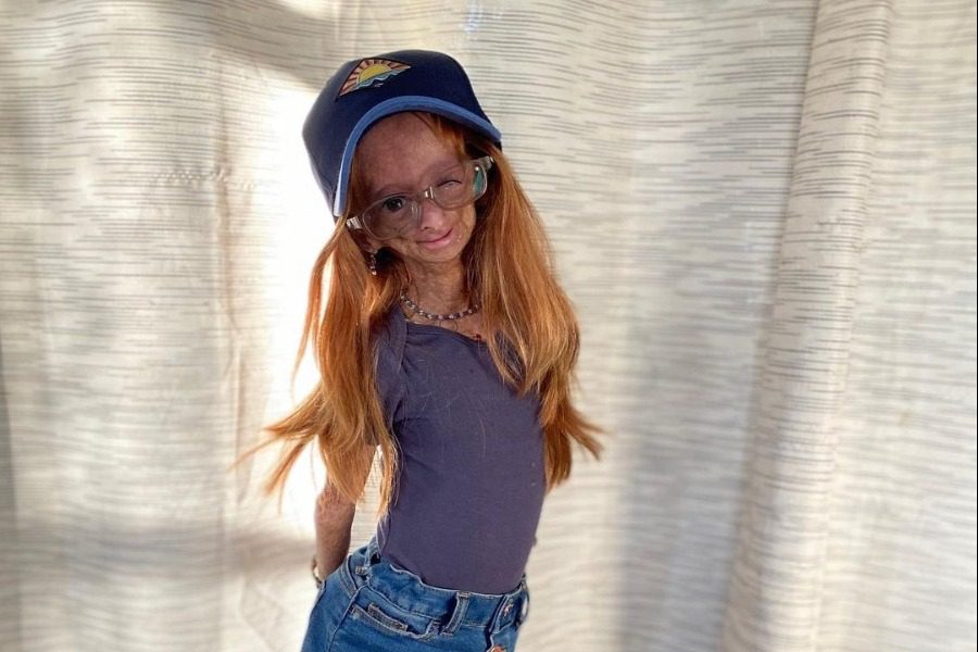 Η ιστορία της Adalia Rose Williams που μας συγκλόνισε από την πρώτη στιγμή