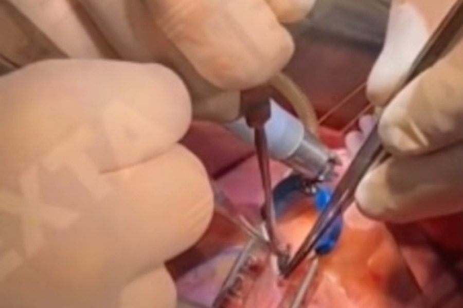 Ουκρανία: Χειρούργοι αφαιρούν σφαίρα από την καρδιά Ουκρανού στρατιώτη