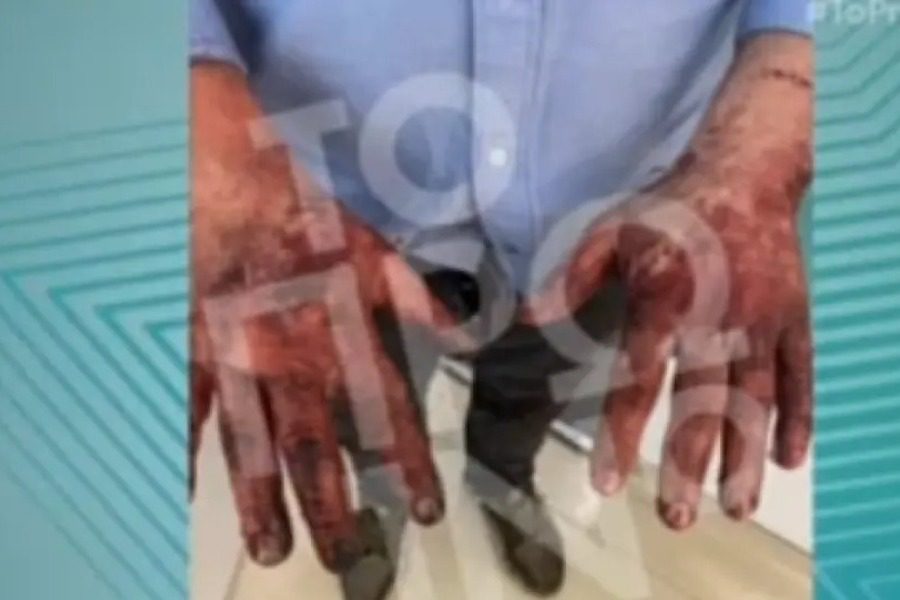 Σοκάρουν οι εικόνες με τα εγκαύματα του ανθρώπου που απεγκλώβισε αυτόν και τη γυναίκα του