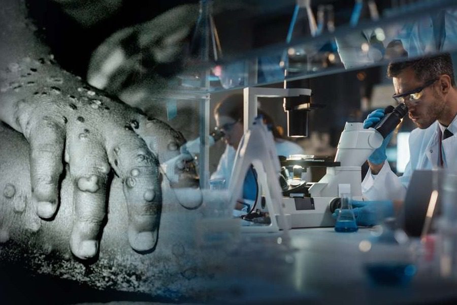 Βασιλακόπουλος για ευλογιά των πιθήκων: «Θα έχουμε περισσότερα κρούσματα»