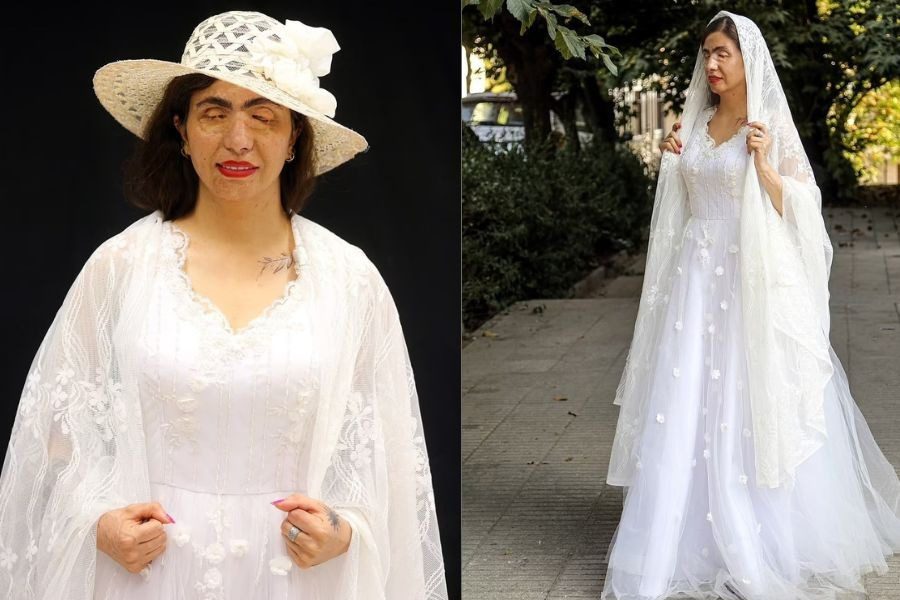 H σχεδιάστρια μόδας που επιλέγει για μοντέλα θύματα επίθεσης με οξύ