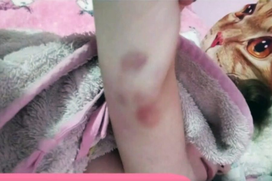 Πάτρα: Φωτογραφία ντοκουμέντο με μελανιές στο σώμα της Τζωρτζίνας