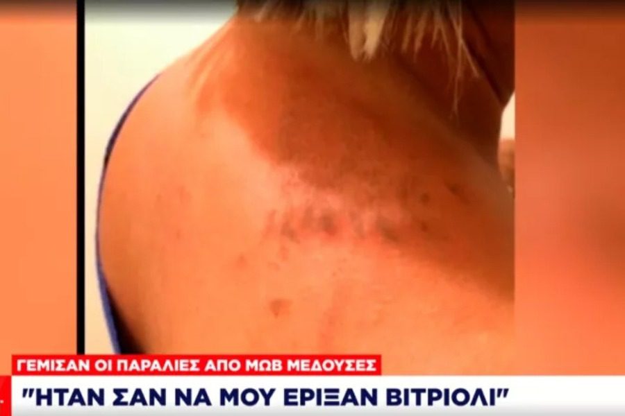 «Δεν μπορείς να περιγράψεις τον πόνο»: Τι δήλωσε γυναίκα που τσιμπήθηκε από μωβ μέδουσα