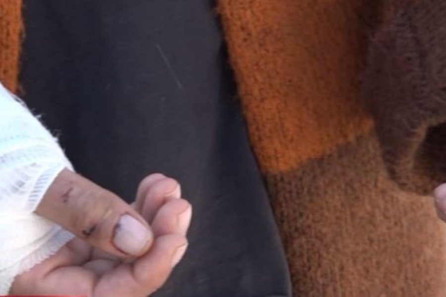 Γλυκά Νερά: Τρόμος για γυναίκα που της επιτέθηκε πίτμπουλ