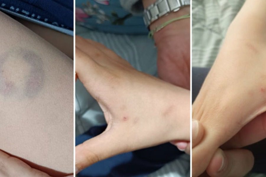 Αρτα: Διευθύντρια σχολείου δάγκωσε 11χρονο μαθητή ΑΜΕΑ