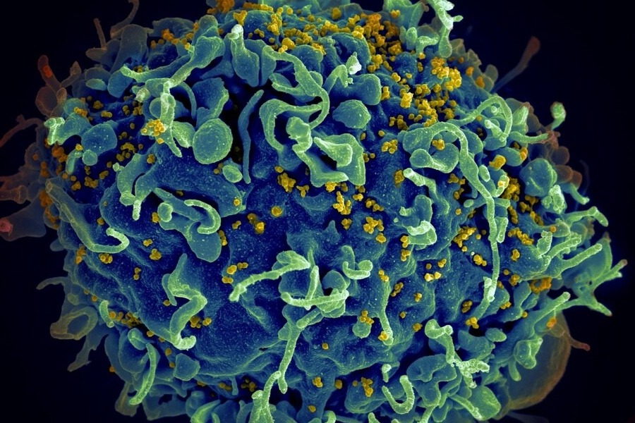 Eλπίδες για θεραπεία του HIV μετά την επιτυχή αφαίρεση του ιού από κύτταρα