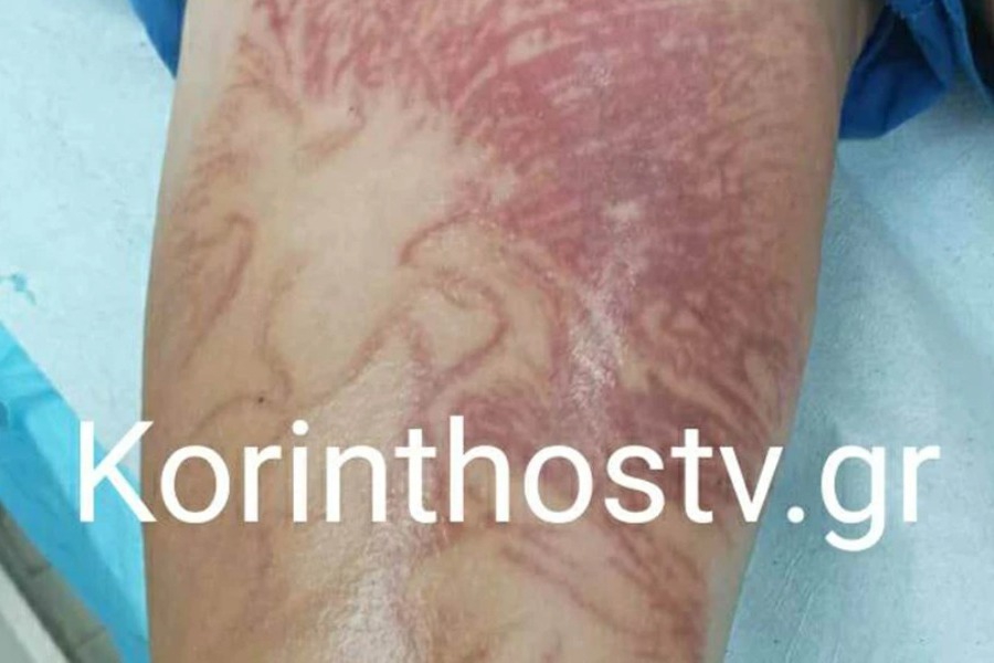 Εσπευσμένα στο νοσοκομείο 9χρονο αγοράκι μετά από τσίμπημα θαλάσσιας ανεμώνης