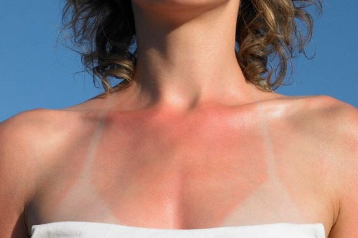 Το αναπάντεχο συστατικό που θα σε βοηθήσει με το ηλιακό έγκαυμα