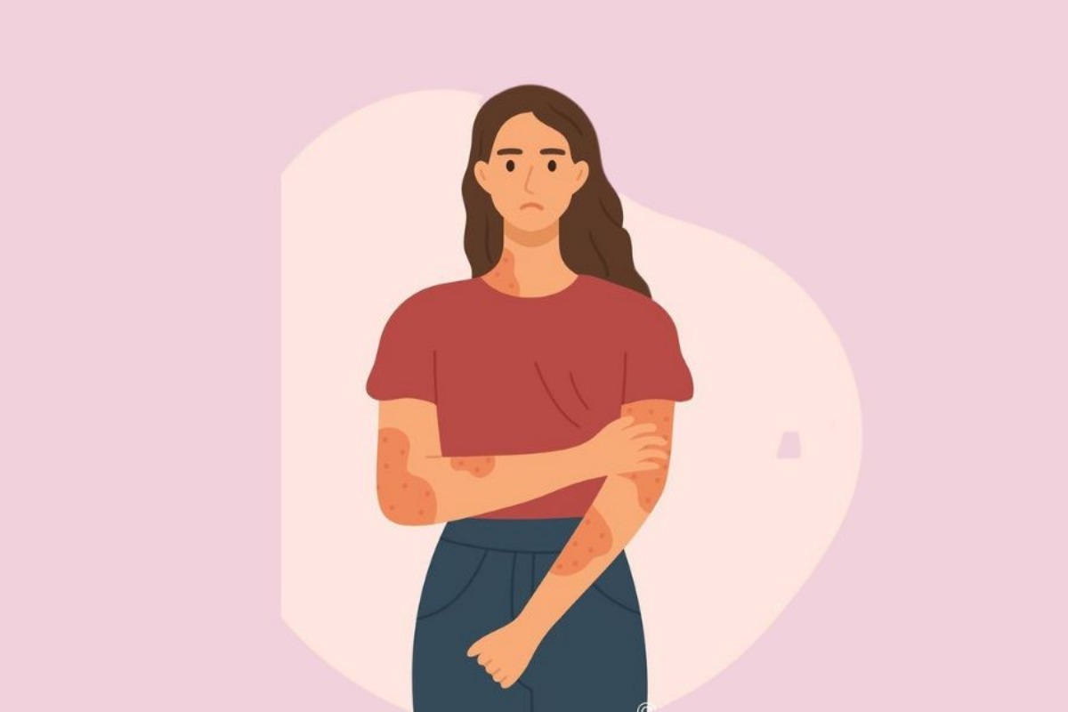 Σημάδια ξηροδερμίας: Τι σημαίνουν και πώς θα τα αντιμετωπίσεις