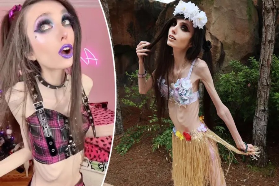 Σάλος με τη YouTuber που έχασε βάρος: «Χτυπά κυριολεκτικά την πόρτα του θανάτου»