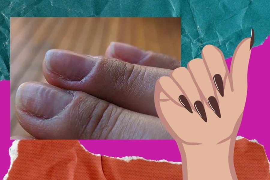 Τι σημαίνει αν τα νύχια σου εμφανίζουν αυτές τις οριζόντιες γραμμές