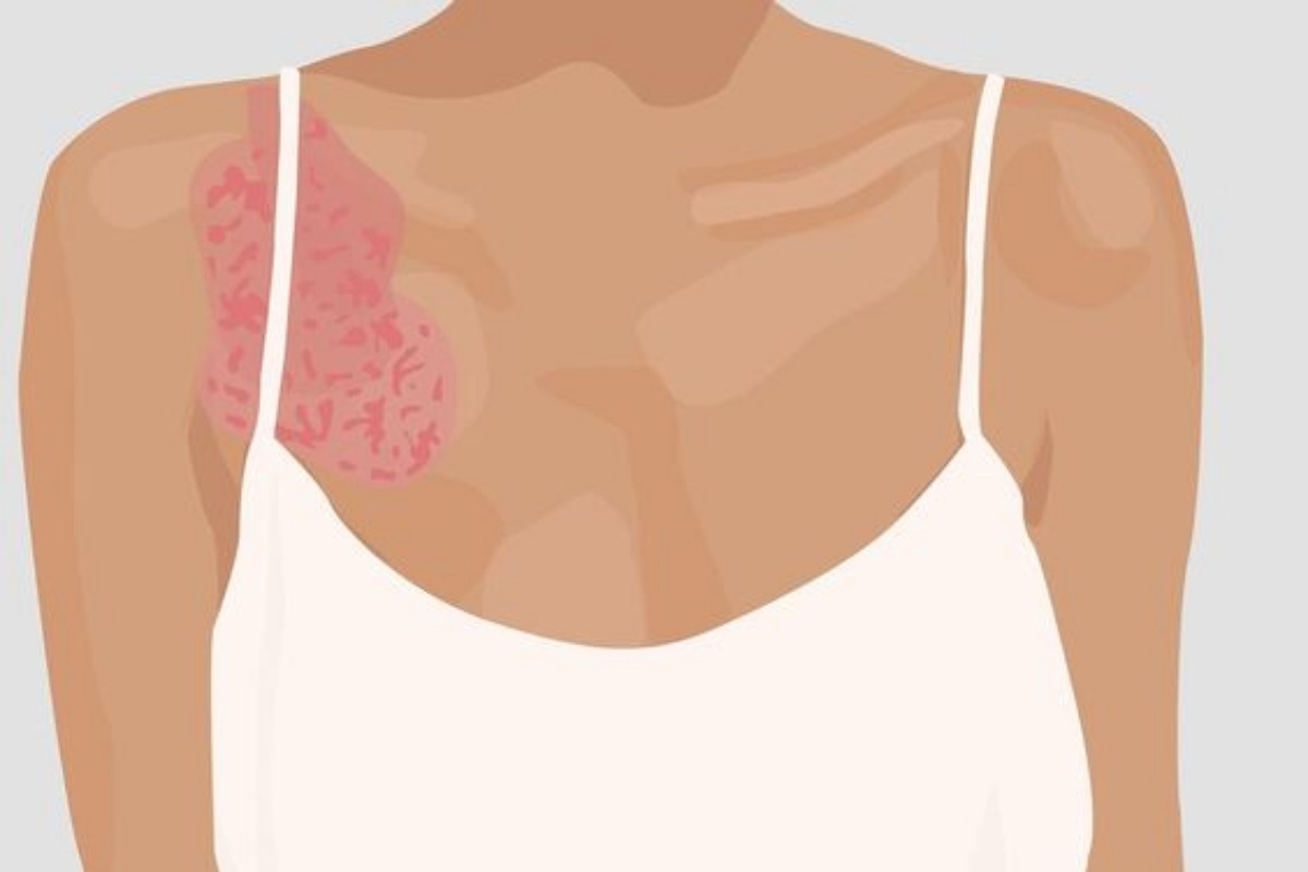 Μύθοι για την ψωρίαση που ίσως δεν γνώριζες