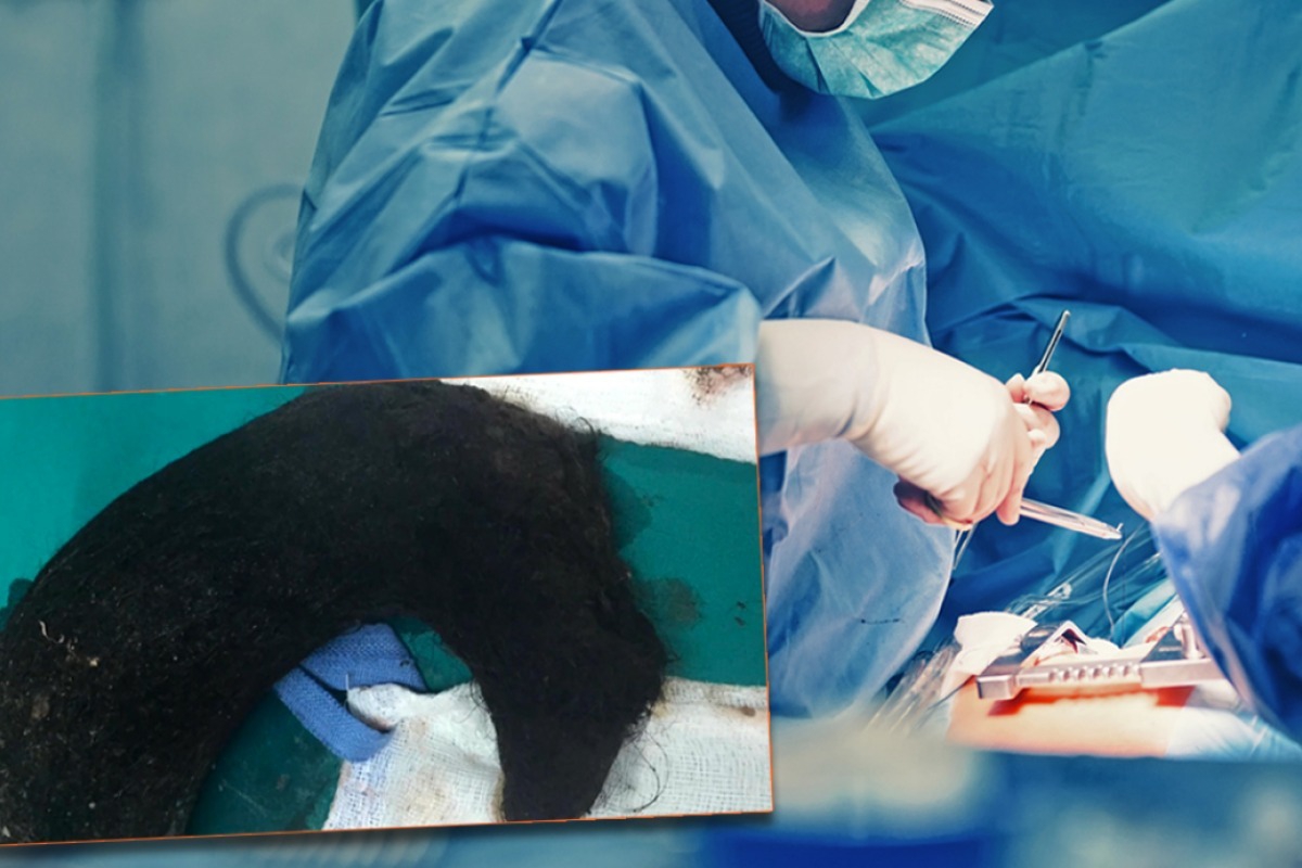 Δείτε τη μάζα που αφαίρεσαν οι γιατροί από το στομάχι της 14χρονης