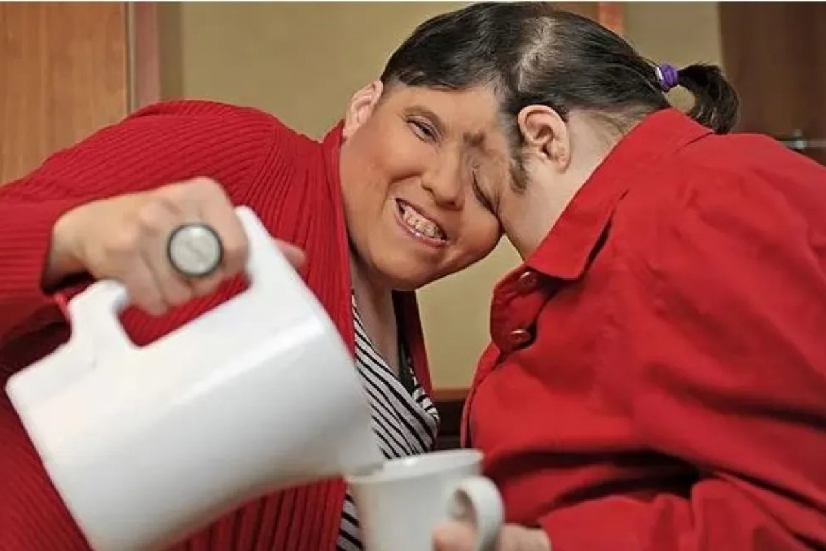 ΗΠΑ: Τα γηραιότερα σιαμαία δίδυμα του κόσμου πέθαναν στα 62 τους