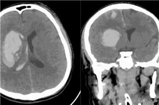 «Καμπανάκι» από επιστήμονες: Ο μύκητας που απειλεί τον εγκέφαλο και αντιστέκεται στα φάρμακα