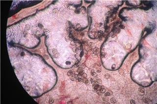 Τρόμος από παρασιτικό σκουλήκι: Προκαλεί καρκίνο και εισβάλλει στο σώμα... χωρίς να το καταλάβεις