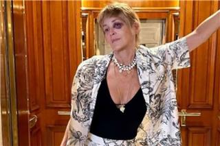 Η Σάρον Στόουν με μαυρισμένο μάτι