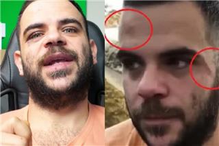 Ο Youtuber Teosty για τον ξυλοδαρμό του στα Γιάννενα: Δείχνω τα σημάδια για να καταλάβουμε ότι η βία είναι πραγματική