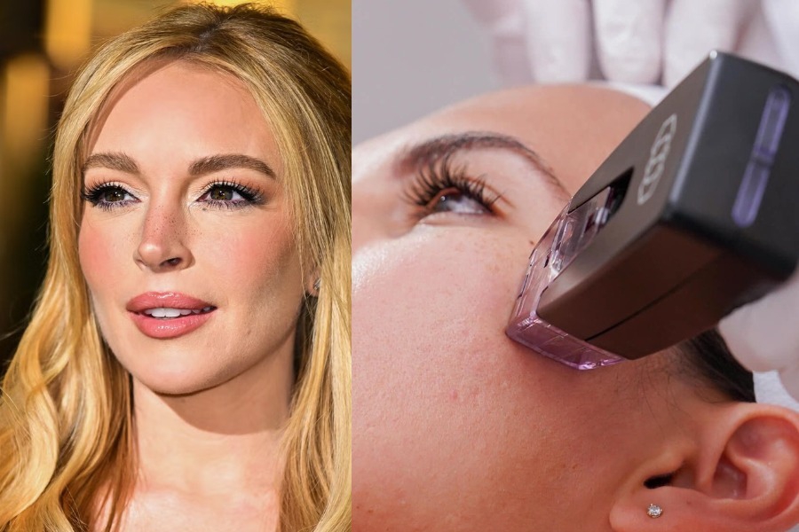 Τι είναι η θεραπεία Morpheus8 που κάνουν οι διάσημες για νεανικό δέρμα;