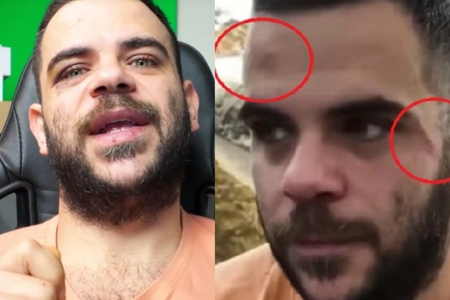 Ο Youtuber Teosty για τον ξυλοδαρμό του στα Γιάννενα: Δείχνω τα σημάδια για να καταλάβουμε ότι η βία είναι πραγματική