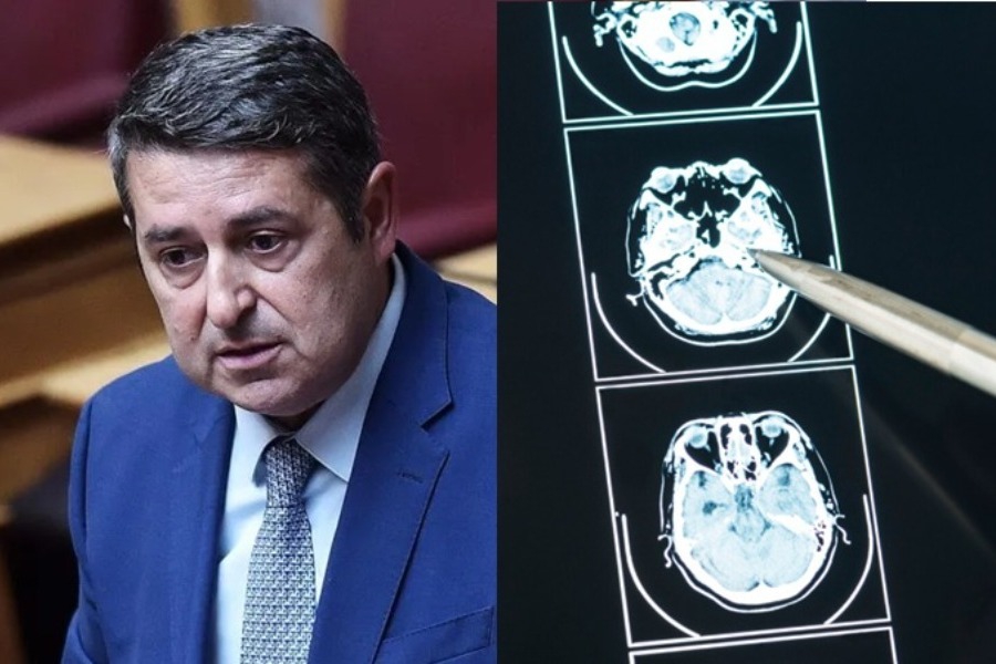 Ανεύρυσμα εγκεφάλου: Τι είναι αυτό που έπαθε ο Γιώργος Μυλωνάκης