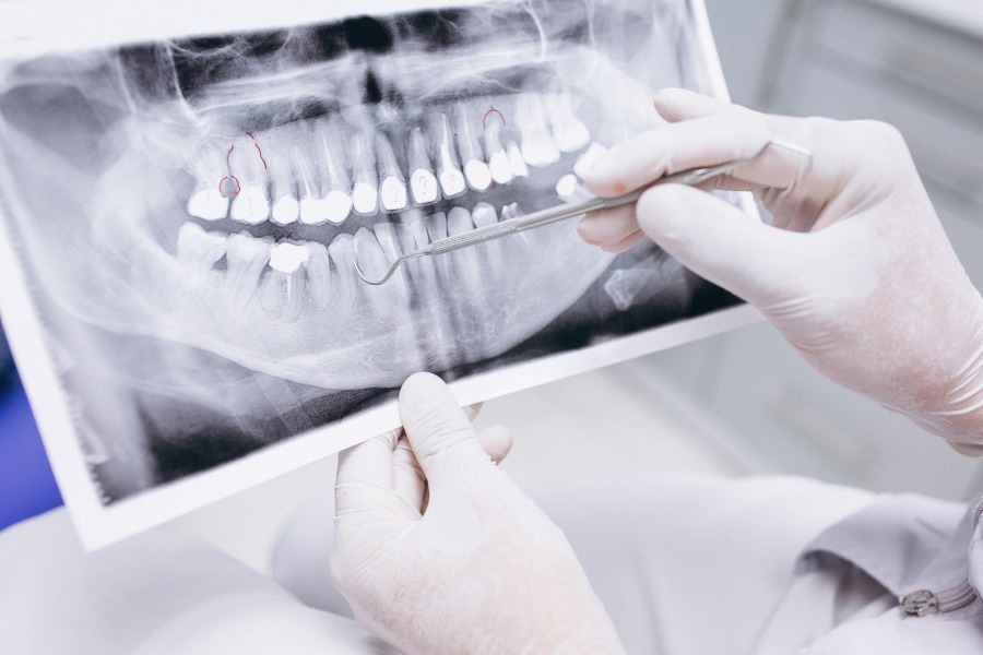 Τι πάθηση έχει ο άνθρωπος με τα περισσότερα δόντια στον κόσμο