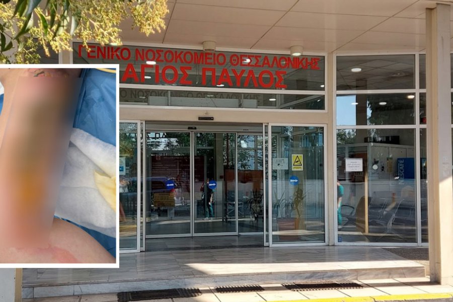 Εφιάλτης για 20χρονη στη Θεσσαλονίκη: Μπήκε στο νοσοκομείο για αφαίρεση κύστης κόκκυγα και κατέληξε με εγκαύματα τρίτου βαθμού