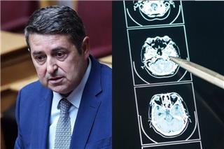 Ανεύρυσμα εγκεφάλου: Τι είναι αυτό που έπαθε ο Γιώργος Μυλωνάκης