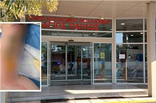 Εφιάλτης για 20χρονη στη Θεσσαλονίκη: Μπήκε στο νοσοκομείο για αφαίρεση κύστης κόκκυγα και κατέληξε με εγκαύματα τρίτου βαθμού