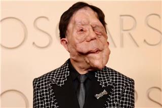 Ανταμ Πέρσον: Συγκλόνισε στο κόκκινο χαλί των Όσκαρ - Η μάχη του με την νευροϊνωμάτωση