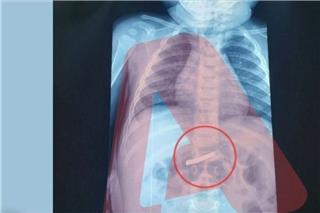 Αγωνία για αγοράκι τριών ετών - Κατάπιε ξυραφάκι