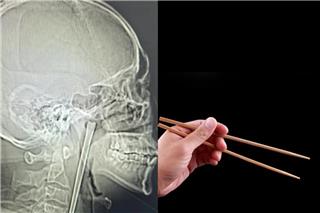 Το πιο παράξενο ιατρικό περιστατικό: Πώς ένας άντρας έζησε 8 χρόνια με ένα μεταλλικό chopstick σφηνωμένο στον λαιμό του