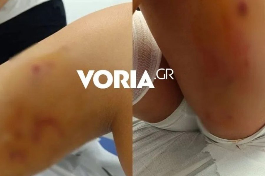 Θεσσαλονίκη: Στιγμές τρόμου για 12χρονη που δέχθηκε επίθεση από αγέλη σκυλιών