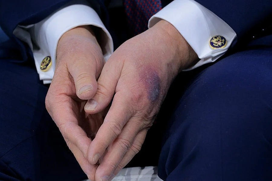 Με μώλωπα ξανά ο Τραμπ: Η εξήγηση που έδωσε για το σημάδι στο αριστερό χέρι